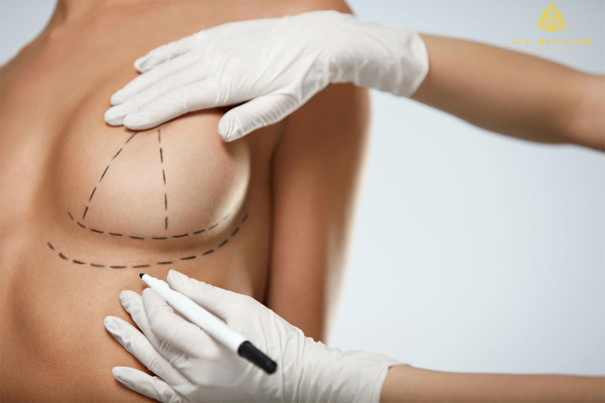 5 Common Myths About Breast Lifts Debunked